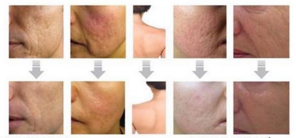 Microneedling- results